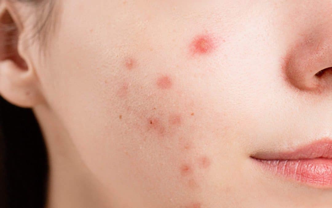 Comment se débarrasser de l’acné grâce à la naturopathie ?